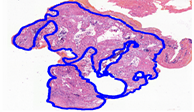 Lung Cancer Segmentation